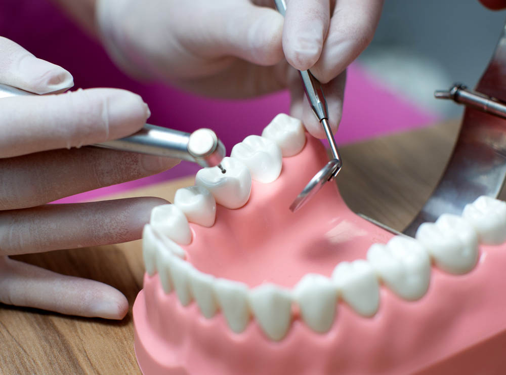 Dental Crown Procedure Issaquah